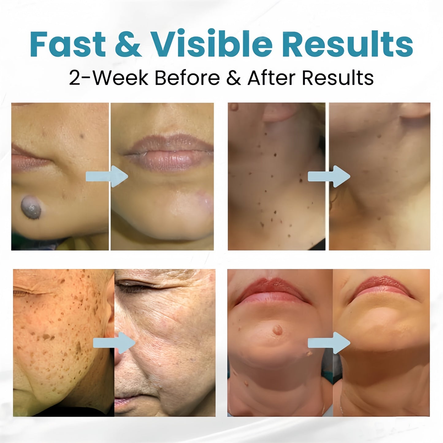 Non-Invasive Mole and Wart Removal Laser Pen